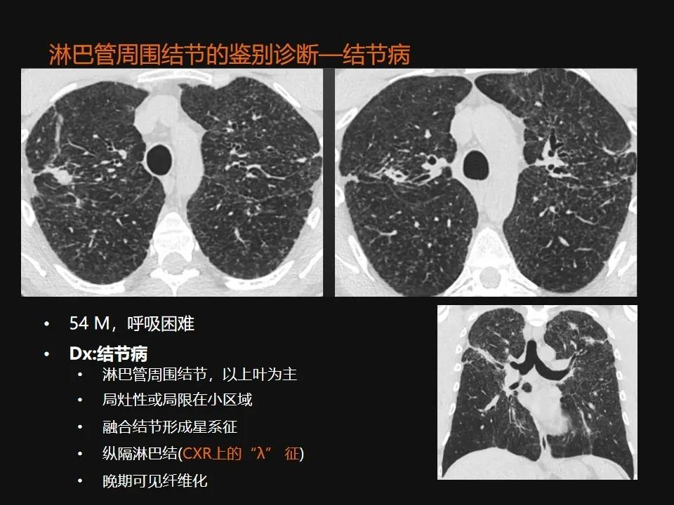 影像PPT - 【PPT】肺微结节的HRCT诊断及鉴别诊断思路-43 影像PPT - 【PPT】肺微结节的HRCT诊断及鉴别诊断思路-43