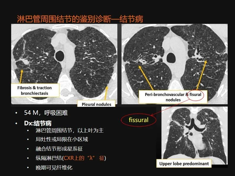 影像PPT - 【PPT】肺微结节的HRCT诊断及鉴别诊断思路-44 影像PPT - 【PPT】肺微结节的HRCT诊断及鉴别诊断思路-44