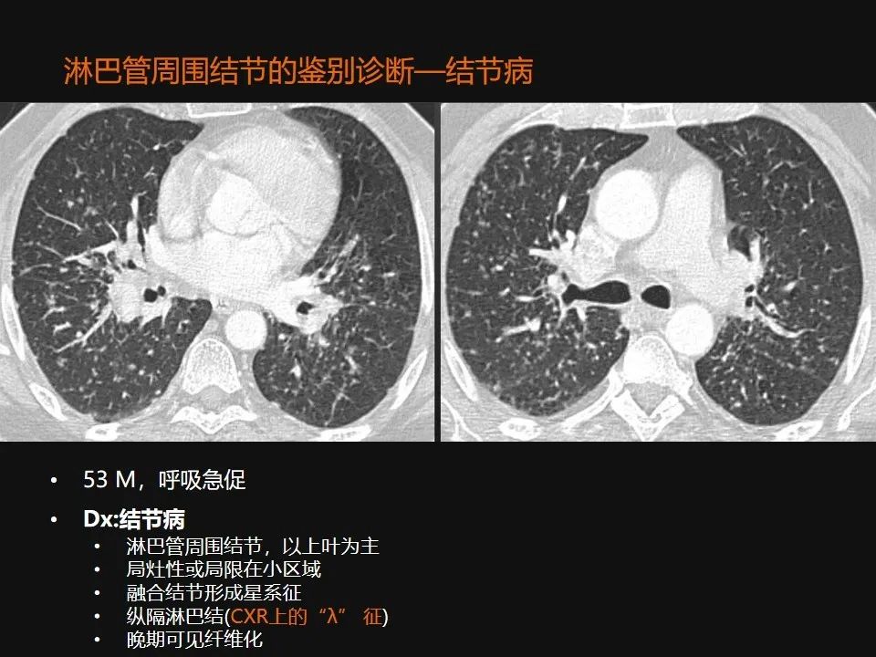 影像PPT - 【PPT】肺微结节的HRCT诊断及鉴别诊断思路-45 影像PPT - 【PPT】肺微结节的HRCT诊断及鉴别诊断思路-45