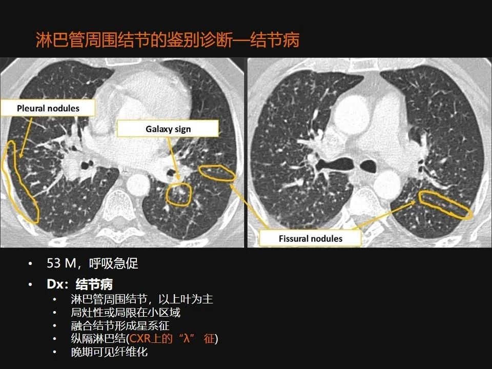 影像PPT - 【PPT】肺微结节的HRCT诊断及鉴别诊断思路-46 影像PPT - 【PPT】肺微结节的HRCT诊断及鉴别诊断思路-46