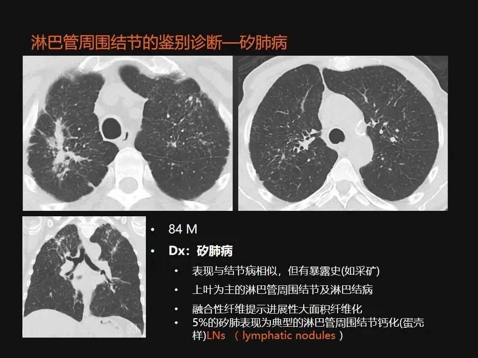 影像PPT - 【PPT】肺微结节的HRCT诊断及鉴别诊断思路-47 影像PPT - 【PPT】肺微结节的HRCT诊断及鉴别诊断思路-47