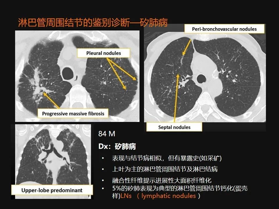 影像PPT - 【PPT】肺微结节的HRCT诊断及鉴别诊断思路-48 影像PPT - 【PPT】肺微结节的HRCT诊断及鉴别诊断思路-48