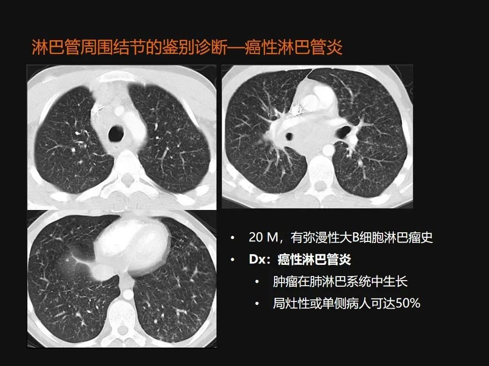影像PPT - 【PPT】肺微结节的HRCT诊断及鉴别诊断思路-49 影像PPT - 【PPT】肺微结节的HRCT诊断及鉴别诊断思路-49