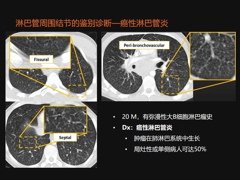影像PPT - 【PPT】肺微结节的HRCT诊断及鉴别诊断思路-50 影像PPT - 【PPT】肺微结节的HRCT诊断及鉴别诊断思路-50