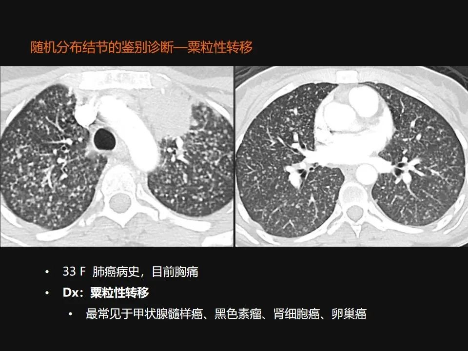 影像PPT - 【PPT】肺微结节的HRCT诊断及鉴别诊断思路-52 影像PPT - 【PPT】肺微结节的HRCT诊断及鉴别诊断思路-52