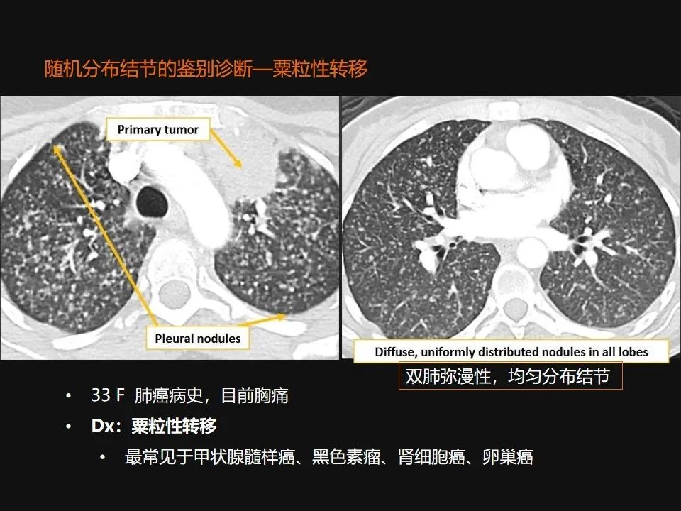 影像PPT - 【PPT】肺微结节的HRCT诊断及鉴别诊断思路-53 影像PPT - 【PPT】肺微结节的HRCT诊断及鉴别诊断思路-53