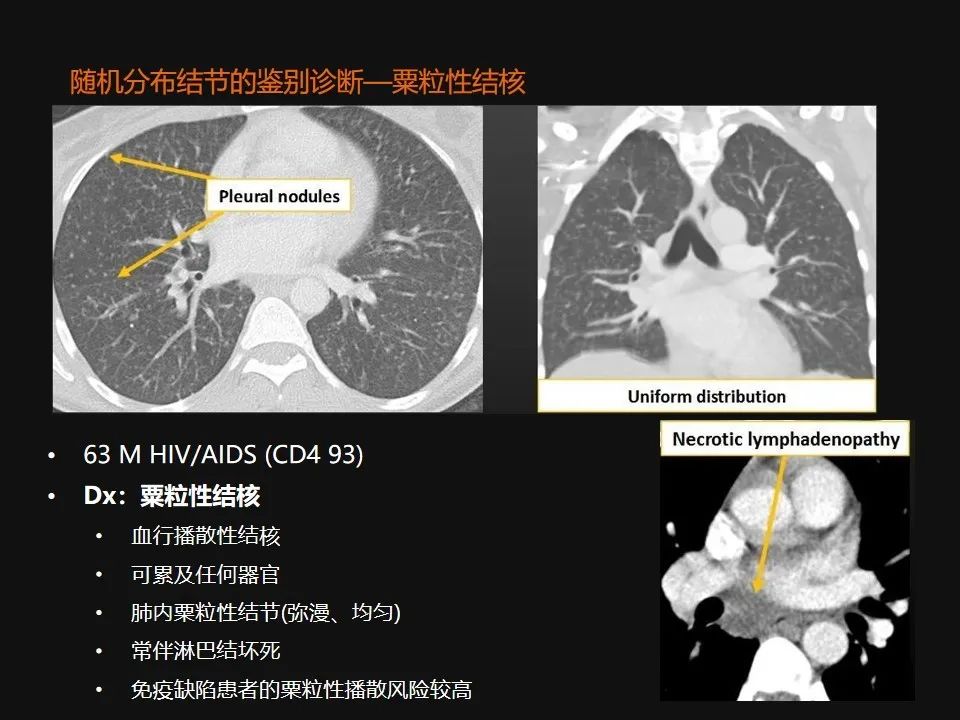 影像PPT - 【PPT】肺微结节的HRCT诊断及鉴别诊断思路-55 影像PPT - 【PPT】肺微结节的HRCT诊断及鉴别诊断思路-55