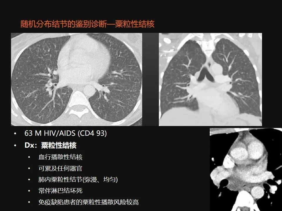 影像PPT - 【PPT】肺微结节的HRCT诊断及鉴别诊断思路-54 影像PPT - 【PPT】肺微结节的HRCT诊断及鉴别诊断思路-54