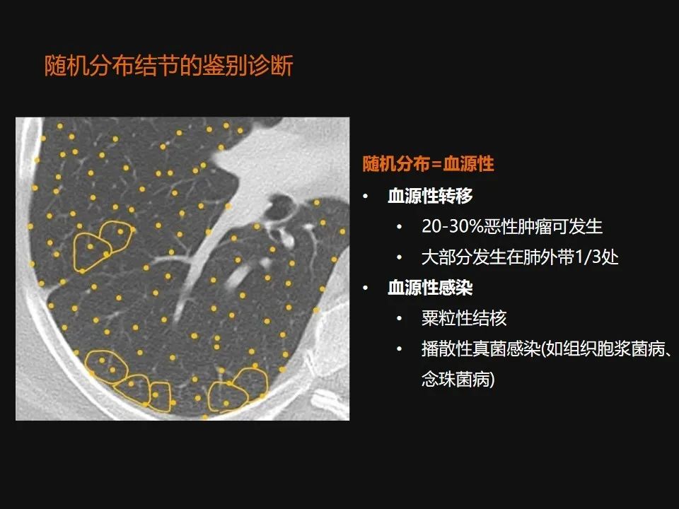 影像PPT - 【PPT】肺微结节的HRCT诊断及鉴别诊断思路-51 影像PPT - 【PPT】肺微结节的HRCT诊断及鉴别诊断思路-51