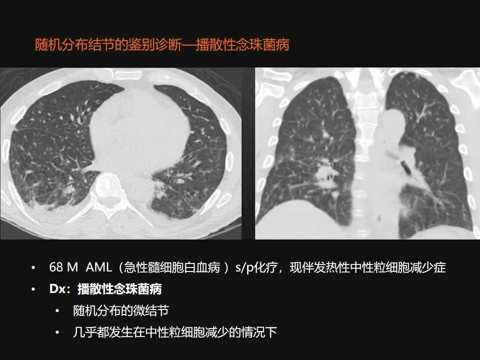 影像PPT - 【PPT】肺微结节的HRCT诊断及鉴别诊断思路-56 影像PPT - 【PPT】肺微结节的HRCT诊断及鉴别诊断思路-56