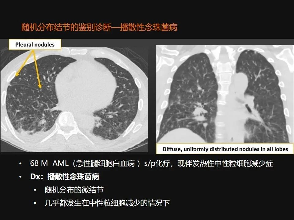 影像PPT - 【PPT】肺微结节的HRCT诊断及鉴别诊断思路-57 影像PPT - 【PPT】肺微结节的HRCT诊断及鉴别诊断思路-57