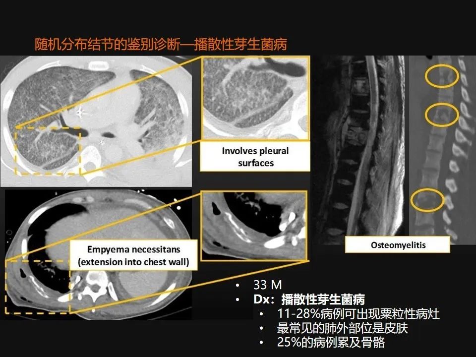 影像PPT - 【PPT】肺微结节的HRCT诊断及鉴别诊断思路-58 影像PPT - 【PPT】肺微结节的HRCT诊断及鉴别诊断思路-58