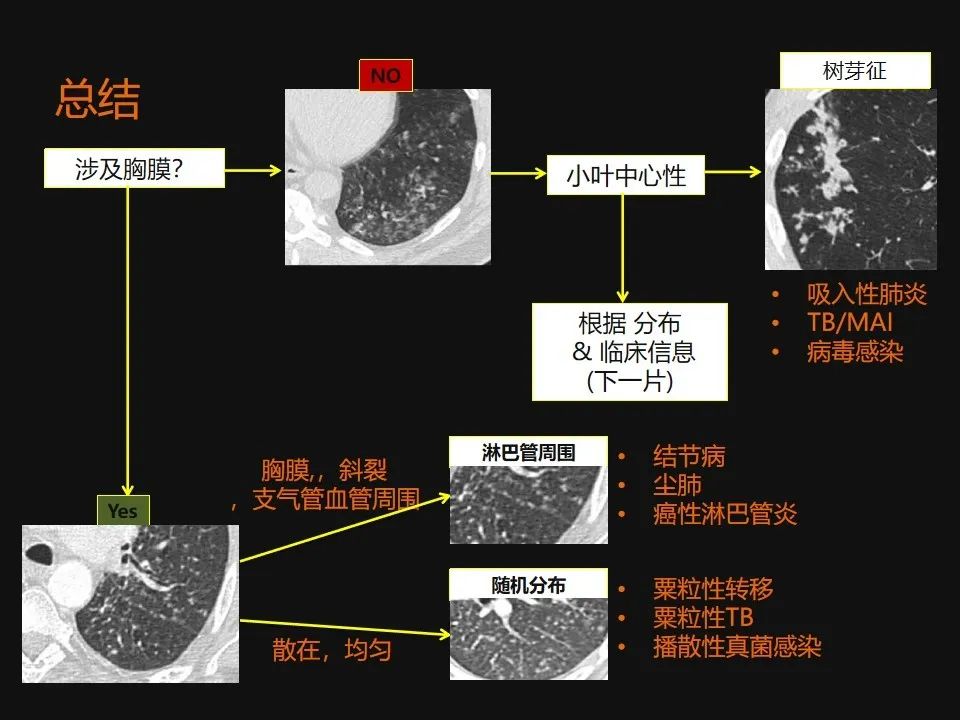 影像PPT - 【PPT】肺微结节的HRCT诊断及鉴别诊断思路-59 影像PPT - 【PPT】肺微结节的HRCT诊断及鉴别诊断思路-59