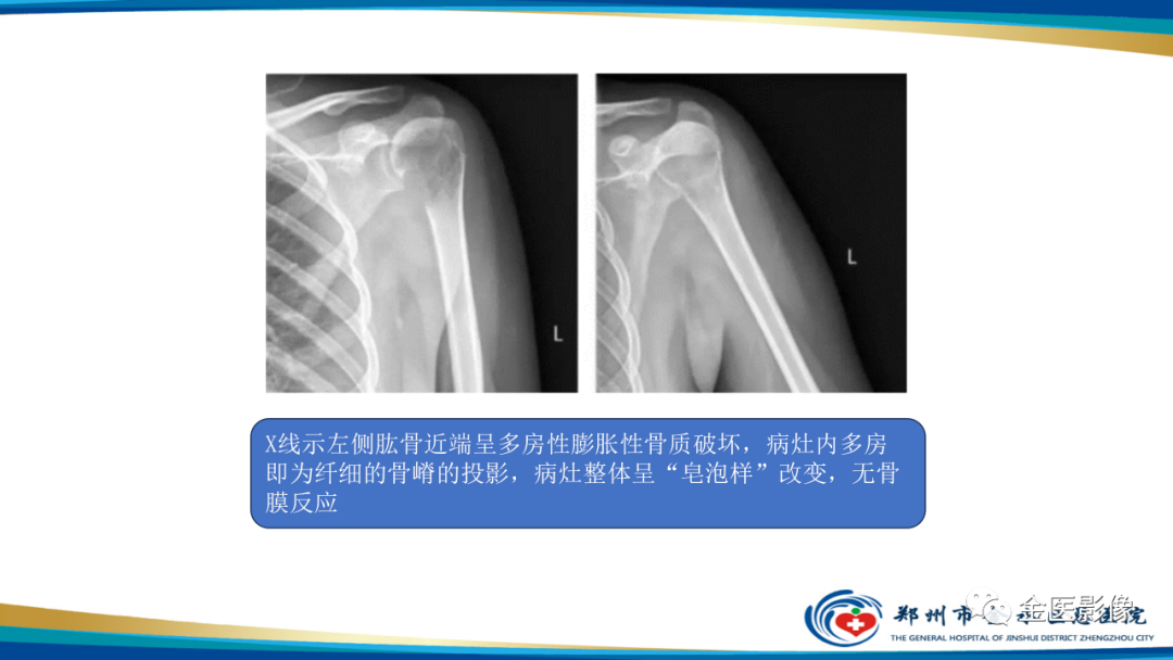 影像PPT - 【PPT】中间型骨肿瘤的影像诊断及鉴别诊断-7