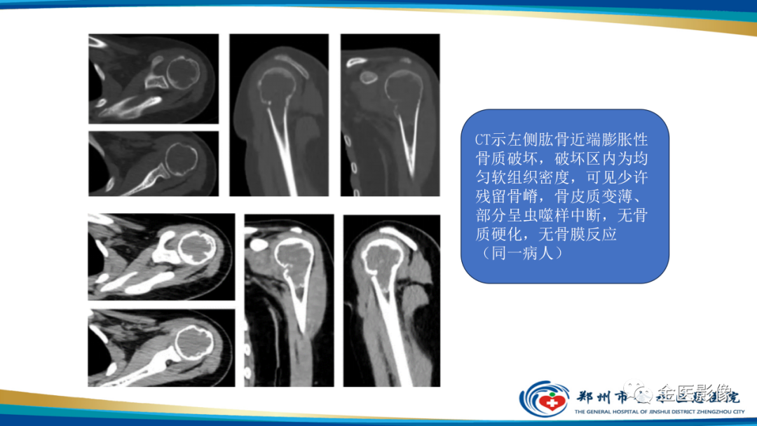影像PPT - 【PPT】中间型骨肿瘤的影像诊断及鉴别诊断-8