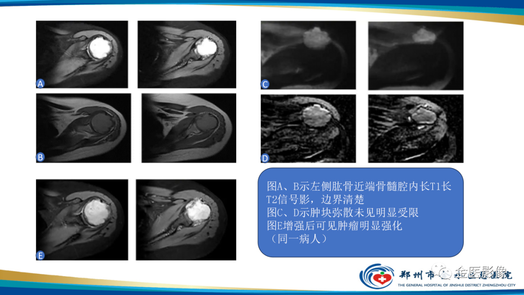 影像PPT - 【PPT】中间型骨肿瘤的影像诊断及鉴别诊断-10