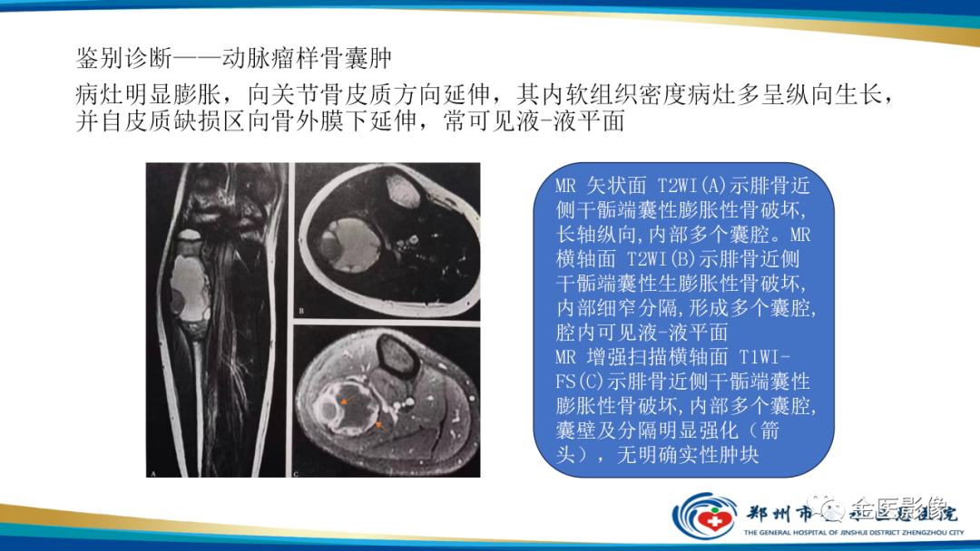 影像PPT - 【PPT】中间型骨肿瘤的影像诊断及鉴别诊断-11