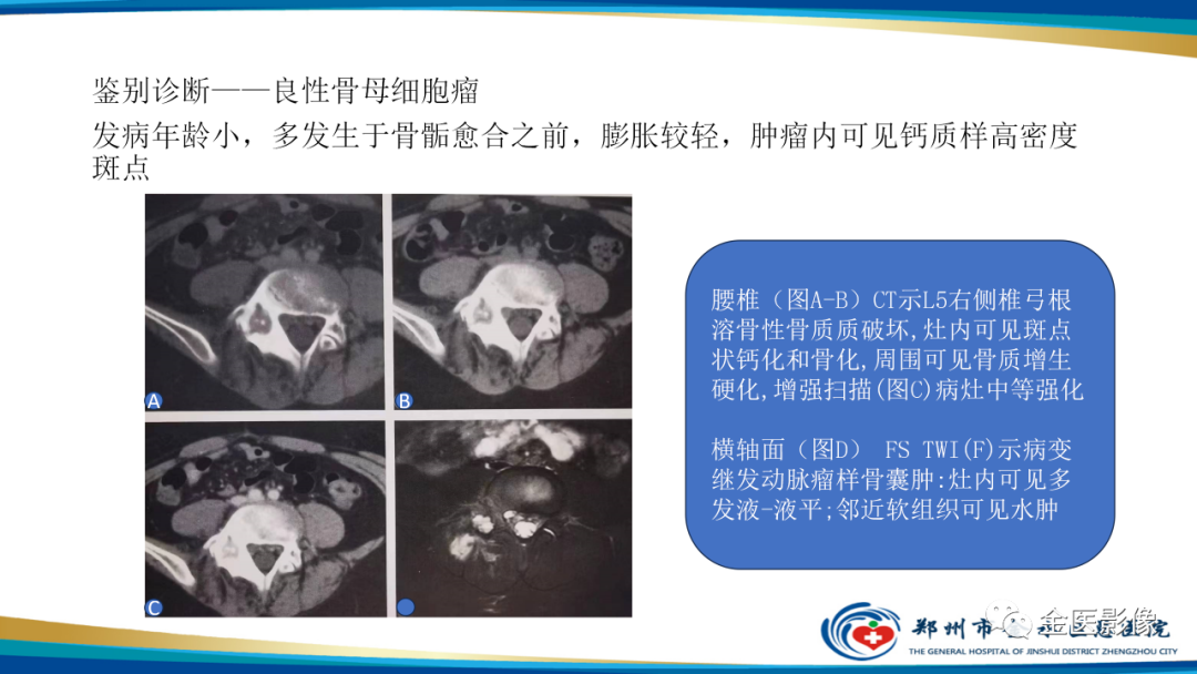 影像PPT - 【PPT】中间型骨肿瘤的影像诊断及鉴别诊断-12