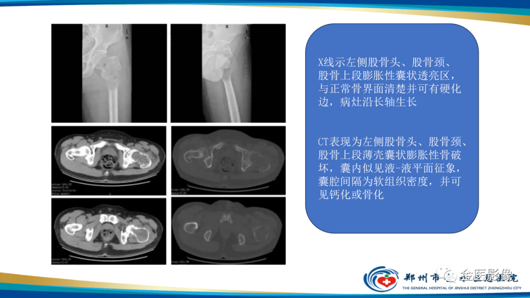 影像PPT - 【PPT】中间型骨肿瘤的影像诊断及鉴别诊断-16