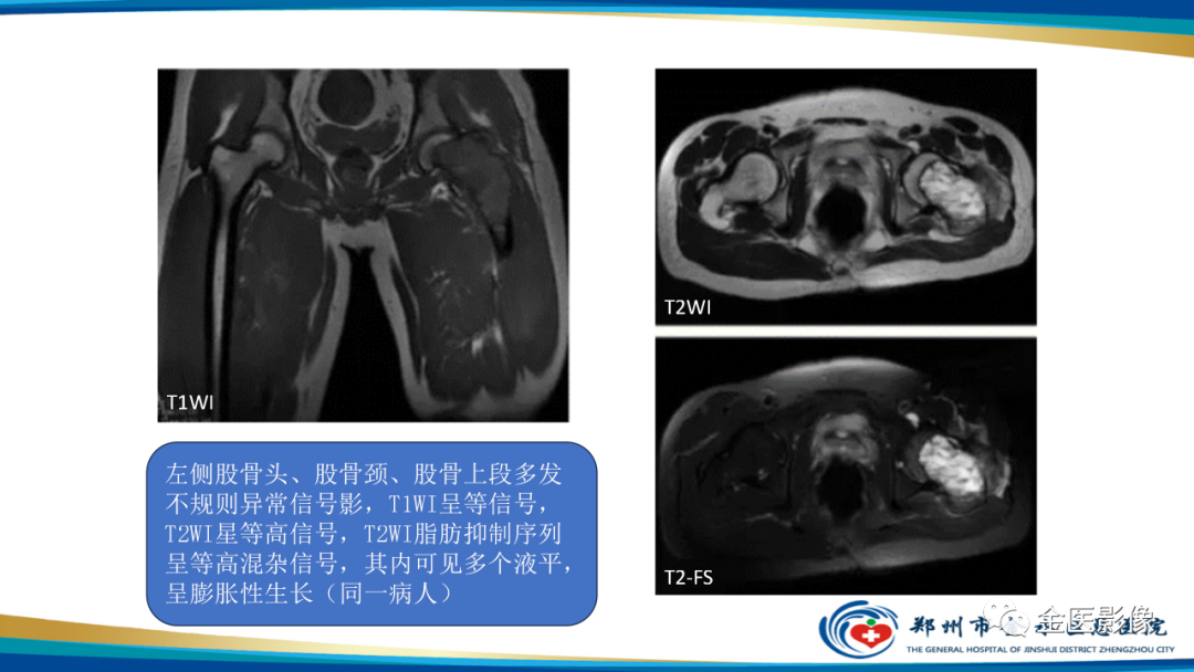 影像PPT - 【PPT】中间型骨肿瘤的影像诊断及鉴别诊断-17