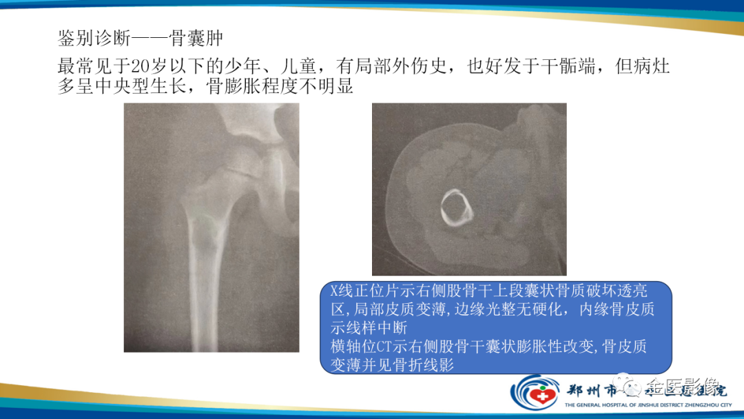 影像PPT - 【PPT】中间型骨肿瘤的影像诊断及鉴别诊断-18