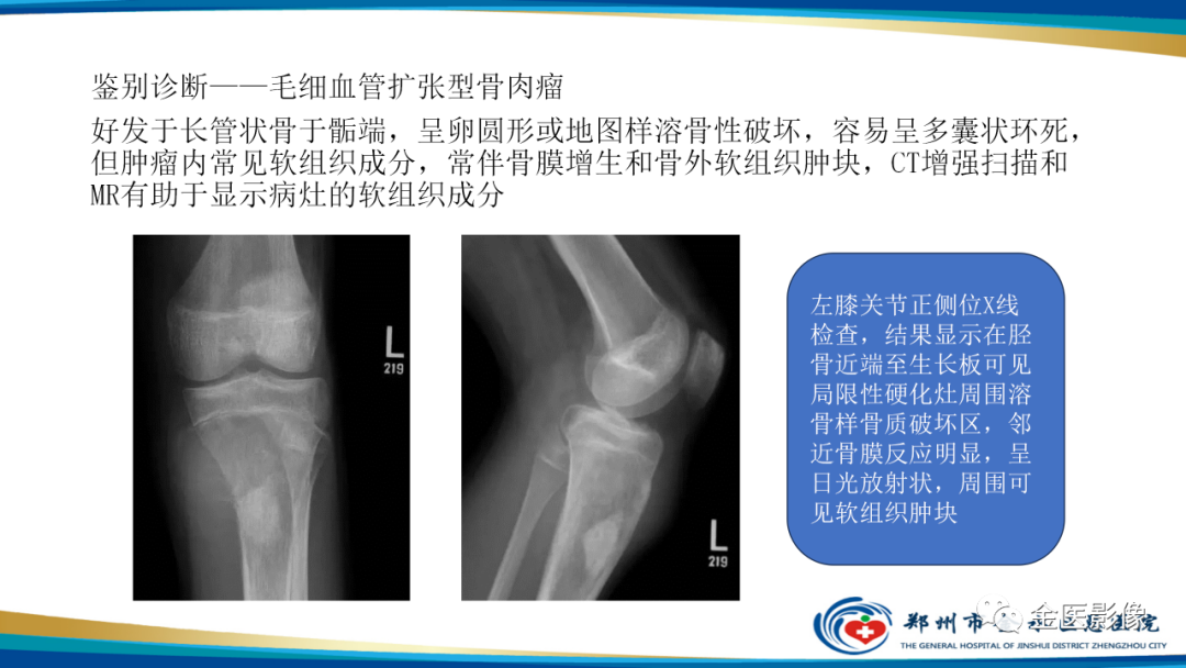 影像PPT - 【PPT】中间型骨肿瘤的影像诊断及鉴别诊断-19