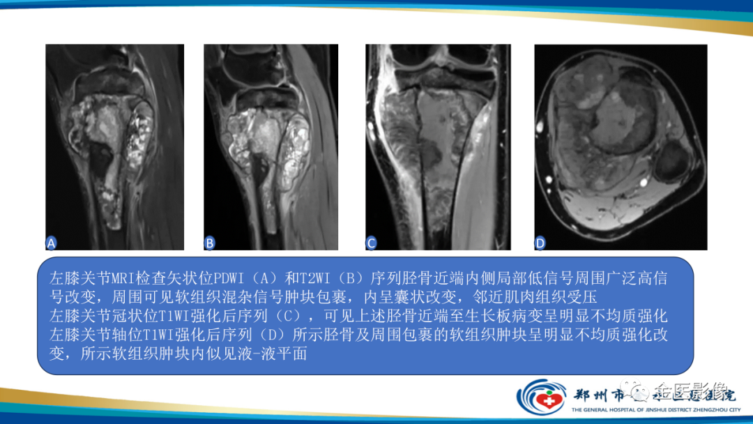 影像PPT - 【PPT】中间型骨肿瘤的影像诊断及鉴别诊断-20