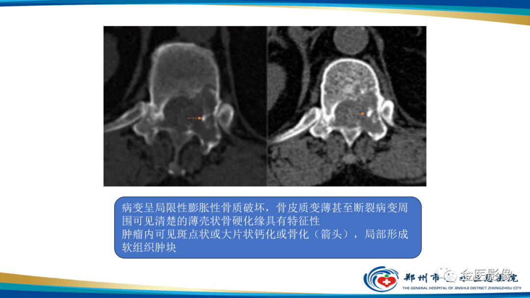 影像PPT - 【PPT】中间型骨肿瘤的影像诊断及鉴别诊断-24