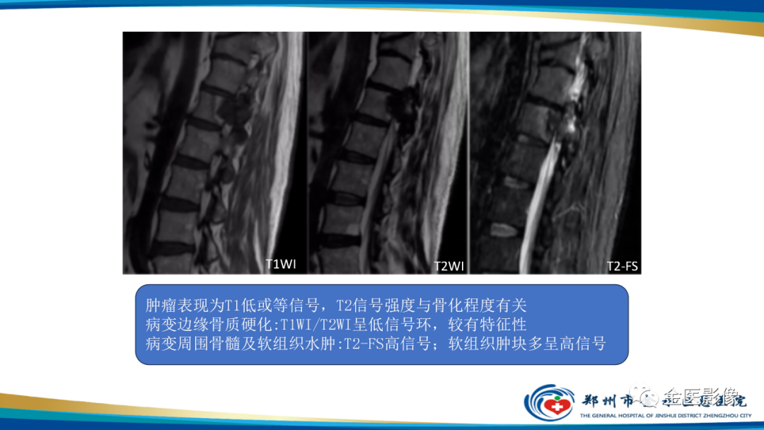 影像PPT - 【PPT】中间型骨肿瘤的影像诊断及鉴别诊断-26