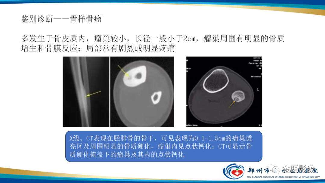 影像PPT - 【PPT】中间型骨肿瘤的影像诊断及鉴别诊断-27