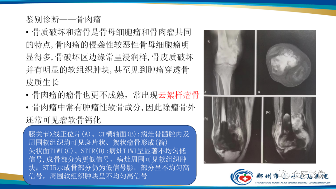 影像PPT - 【PPT】中间型骨肿瘤的影像诊断及鉴别诊断-28