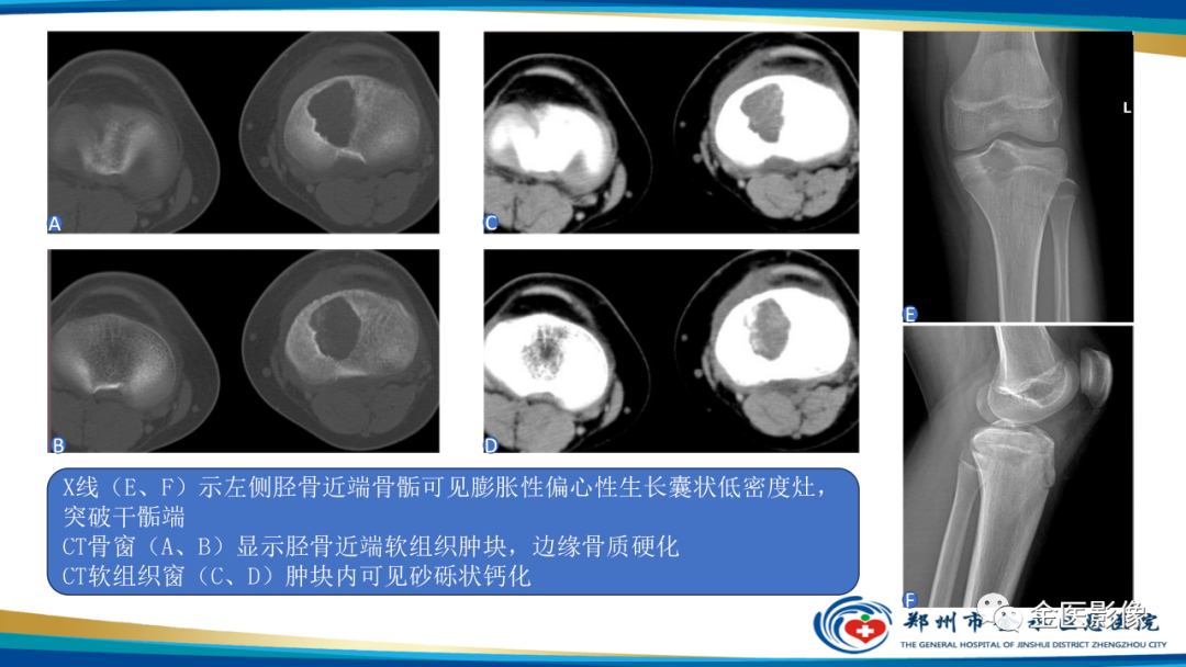 影像PPT - 【PPT】中间型骨肿瘤的影像诊断及鉴别诊断-32