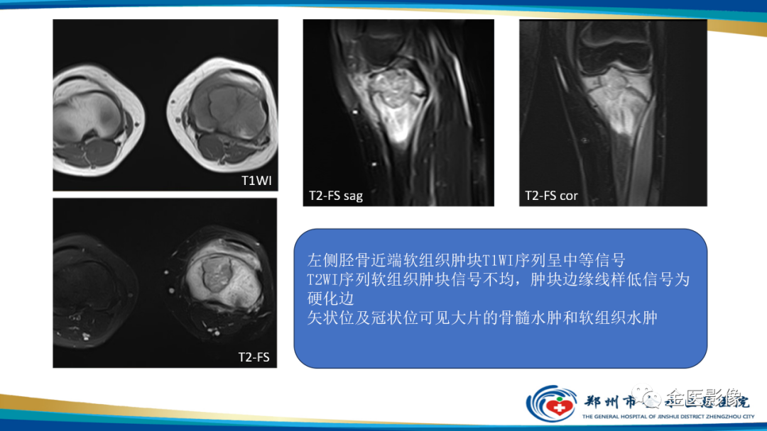 影像PPT - 【PPT】中间型骨肿瘤的影像诊断及鉴别诊断-34