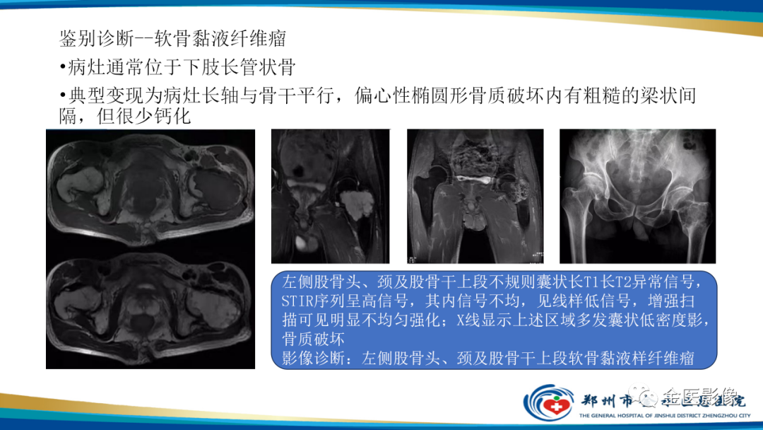 影像PPT - 【PPT】中间型骨肿瘤的影像诊断及鉴别诊断-35