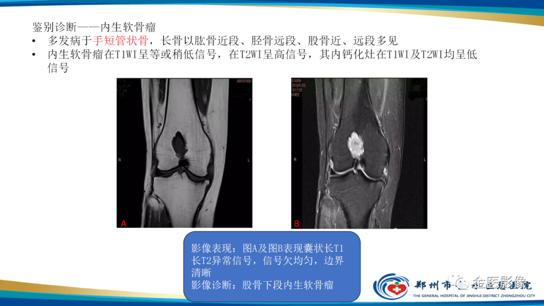 影像PPT - 【PPT】中间型骨肿瘤的影像诊断及鉴别诊断-36