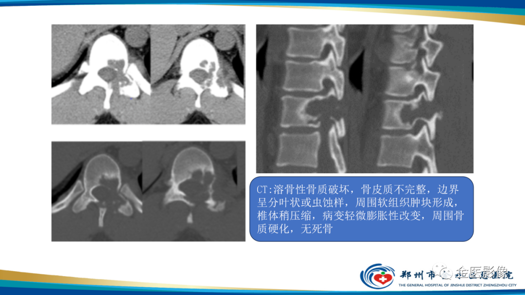 影像PPT - 【PPT】中间型骨肿瘤的影像诊断及鉴别诊断-41
