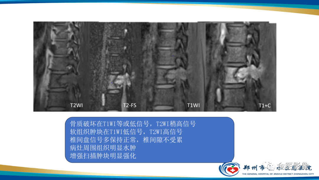 影像PPT - 【PPT】中间型骨肿瘤的影像诊断及鉴别诊断-42