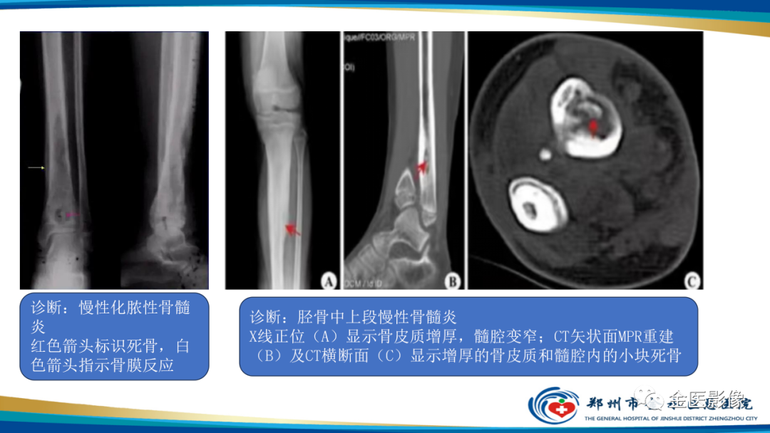 影像PPT - 【PPT】中间型骨肿瘤的影像诊断及鉴别诊断-44