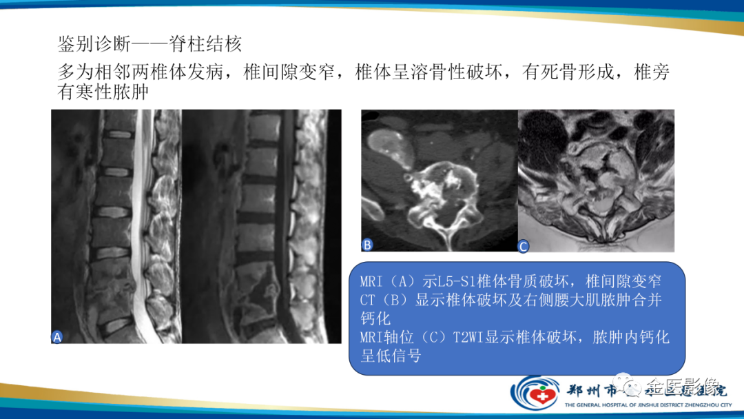 影像PPT - 【PPT】中间型骨肿瘤的影像诊断及鉴别诊断-45
