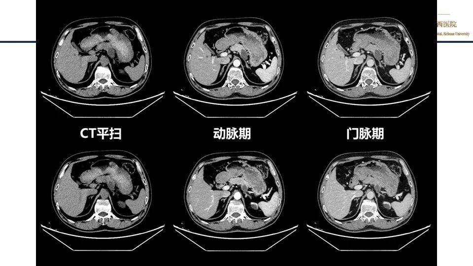 影像PPT - 【PPT】胰腺神经内分泌肿瘤-4