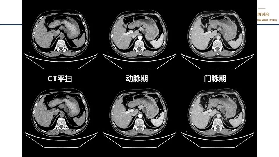 影像PPT - 【PPT】胰腺神经内分泌肿瘤-3