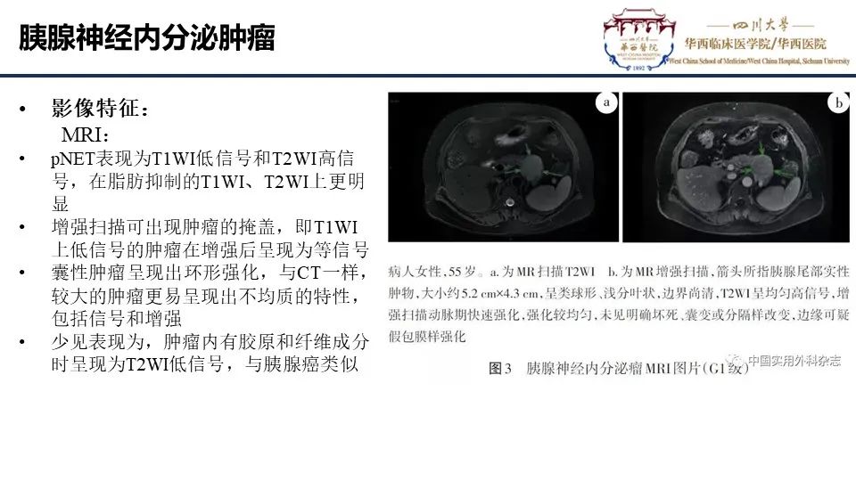 影像PPT - 【PPT】胰腺神经内分泌肿瘤-12