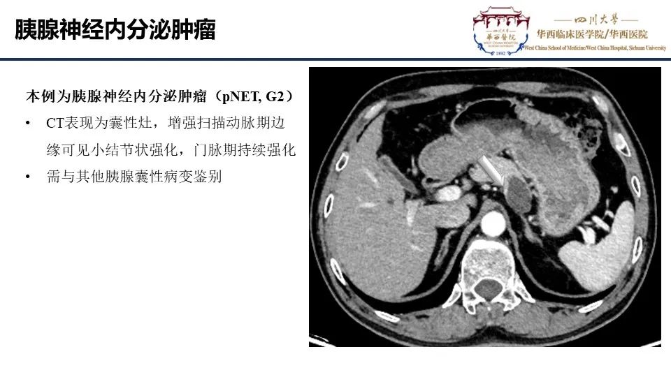 影像PPT - 【PPT】胰腺神经内分泌肿瘤-13