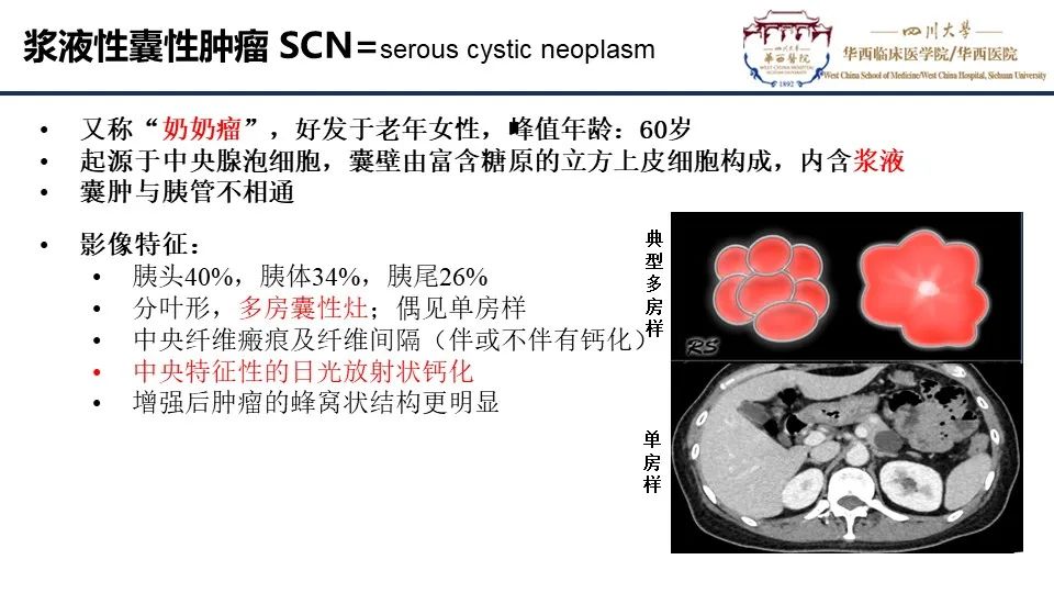 影像PPT - 【PPT】胰腺神经内分泌肿瘤-17