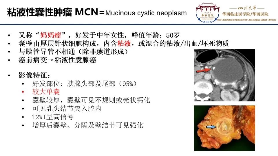 影像PPT - 【PPT】胰腺神经内分泌肿瘤-18