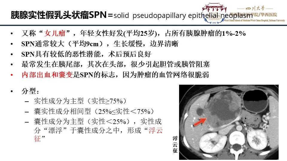 影像PPT - 【PPT】胰腺神经内分泌肿瘤-20