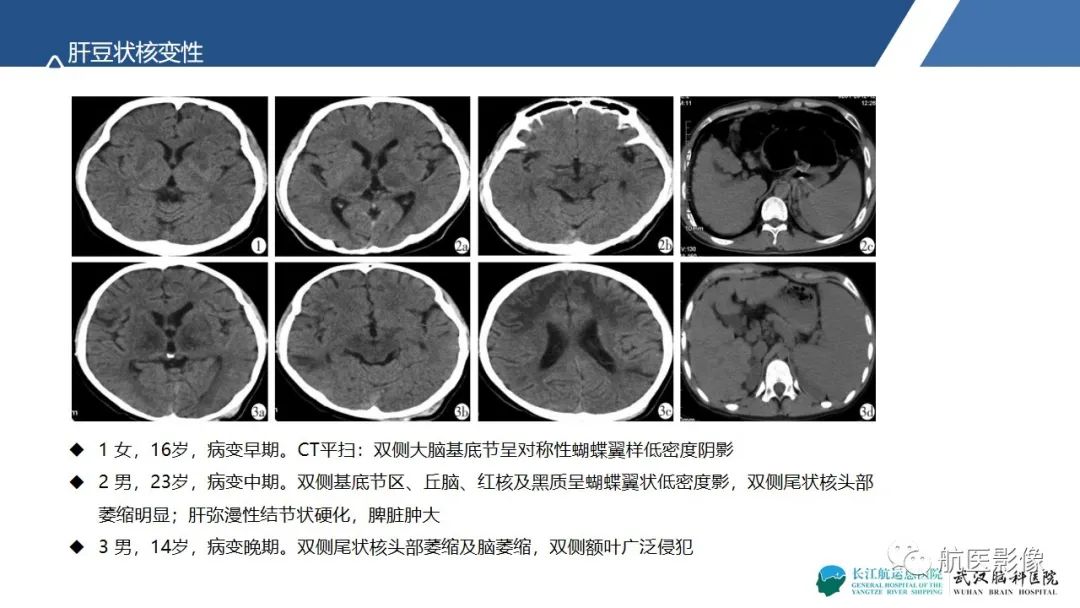 影像PPT - 【PPT】基底节区、丘脑对称性病变影像表现-12