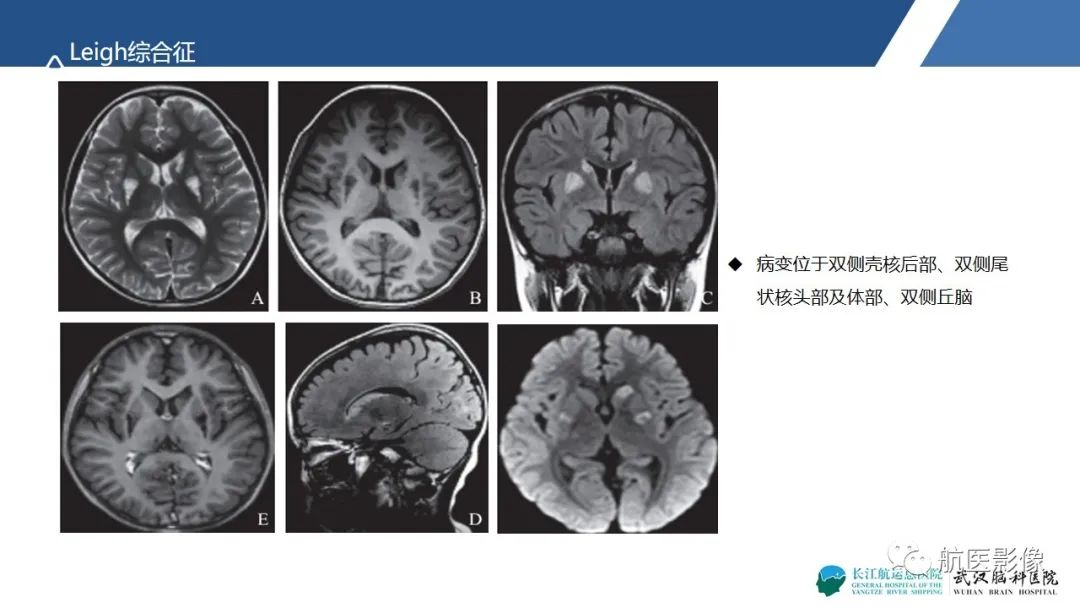 影像PPT - 【PPT】基底节区、丘脑对称性病变影像表现-17