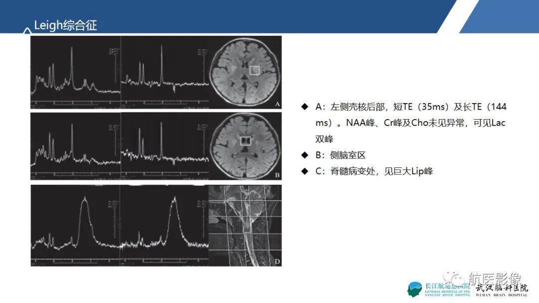 影像PPT - 【PPT】基底节区、丘脑对称性病变影像表现-18