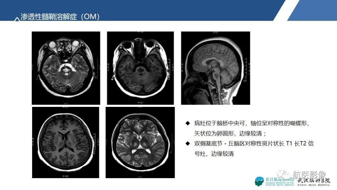 影像PPT - 【PPT】基底节区、丘脑对称性病变影像表现-20